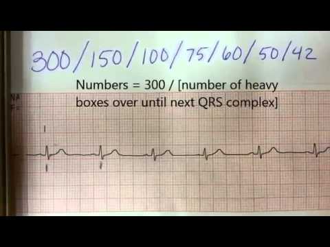 How to find heart rate (pulse) from EKG How to find heart rate (pulse) from EKG