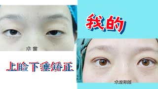 姑娘双眼先天性上睑下垂左眼重 大小眼明显