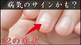 【雑学】爪に縦の線があると・・・ 爪を見るだけで健康状態が分かる！この12の症状は病気のサイン？