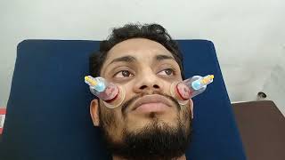 4 yrs of pimples and suffering treated with cupping/ hijama on face | Dr. Mohammed Zaid Tai