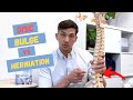 Bulging Disc vs Herniated Disc – What's the Difference?