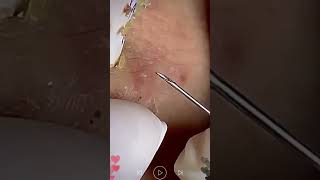 blackhead removal from nose/ old aged blackheads removal