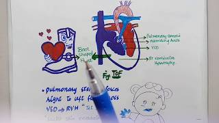 What are congenital heart defects? What is ASD/VSD/PDA/ Tetralogy of fallot/ coarctaction of aorta