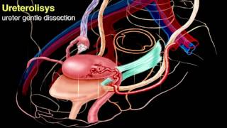 Rectovaginal endometriosis with right ureter obstruction