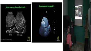 SonoSchool Advanced POCUS | VExUS Score Lecture