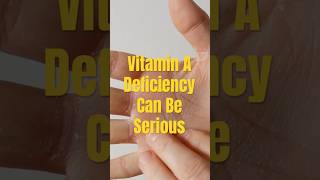 Top Symptoms of VITAMIN A Deficiency #vitamindeficiency #vitamina #shorts