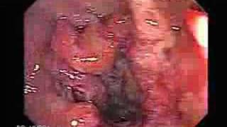 Colonoscopy of a rectal Cancer with Hemorrhoids