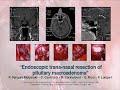 Endoscopic endonasal resection of pituitary macroadenoma