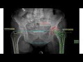 manual hip plan in medicad 2d