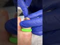 complete nail removal saving a toe from repetitive shoe trauma