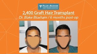 Dr. Blake Bloxham | 2,400 Graft Hair Transplant on \