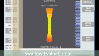 Distensibility Testing of the Pharyngo-Esophageal Segment using EndoFLIP