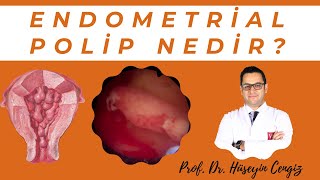 ENDOMETRİAL POLİP NEDİR?💥  (Rahim içi polip ve tedavisi)