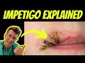 Doctor explains impetigo - causes, types and treatment + REAL PHOTOS | Doctor O'Donovan