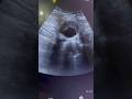 AAA, Abdominal Aortic Aneurysm with mural thrombosis Sonography, ARDMS ultrasound