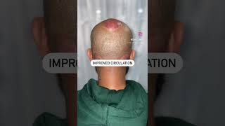 PERFORMING HIJAMA (Wet Cupping) on the Head