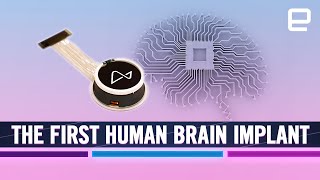 Elon Musk’s Neuralink brain implant: New era of 