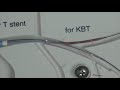 dk crush bifurcation stenting.