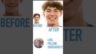 How to show more teeth when you smile! #orthodontics #orthodontictreatment #tads