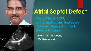 Atrial Septal Defect: X-ray, ECG, Echo, TEE, Device Closure