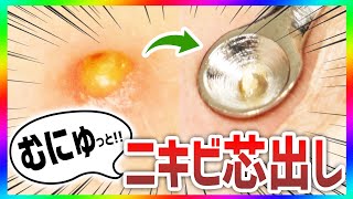 【ニキビからにゅるにゅる】ニキビから大量の\