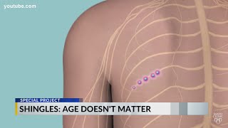 Shingles: Your age doesn't matter. How to lessen the severity
