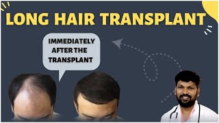 #DrJohnWatts | Is Long Hair Transplantation Better? | Best Hair Specialist in Hyderabad Explains