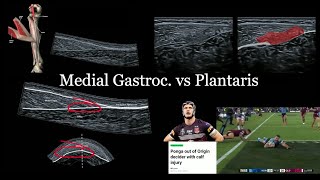 Medial Gastroc vs Plantaris