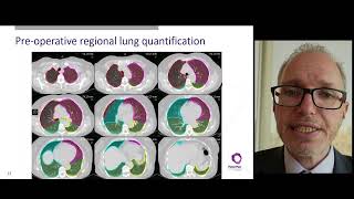 Quantitative Pet As A Catalyst For Precision Oncology