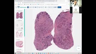 Prof. JFのレクチャー　Pathology of Diffuse Lung Disease - LCH and LAM