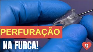 PRIMEIRO PASSO PRA VEDAR UMA PERFURAÇÃO NA FURCA SEM O PACIENTE PERDER O DENTE!