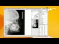 OnyxCeph³™ Module Digitize 2D (Lateral Ceph)