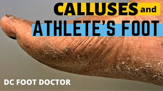 Calluses and Athlete's Foot, A Tough Combination