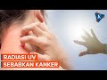 Radiasi Ultraviolet Bisa Picu Kanker Kulit