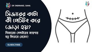 সিজারের কাটা কী পেস্টিং করে জোড়া হয়? | Dr Indranil Saha