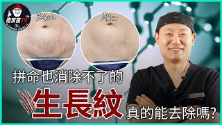 【韓國德萊茵】生長紋和妊娠紋的救星，比激光更有效的治療方法，幹細胞疤痕治療