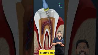 வேர் சிகிச்சை எப்படி செய்வார்கள்? How the Root Canal is Done? | Dr.Karthikeyan | Denta Kings