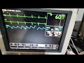 ge dash 3000 patient monitor cardiac complete diagnosis and demonstration