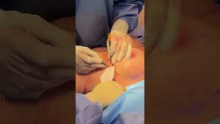 Breast augmentation with Dr. Bruno 🍒 #breastaugmentationsurgery #breastimplantsurgery #shorts