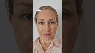 Anti-aging surgeries in Korea💗 #facelift #plasticsurgerykorea #antiaging