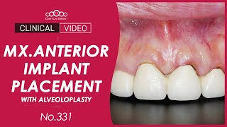 Immediate implant Placement on Mxillary Anterior Area [Dr. Cho Yongseok]