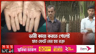 বিরল রোগের সন্ধান, পাওয়া যায় না আঙুলের ছাপ | Adermatoglyphia | The family with no fingerprints