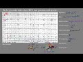 ekg ecg of the week 10 the ekg guy www.ekg.md