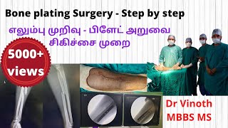 Bone plating Surgery | Step by Step | எலும்புகளில் வைக்கப்படும் பிளேட் அறுவை சிகிச்சை - Dr Vinoth