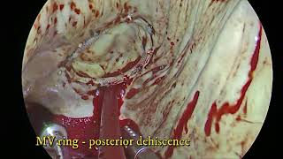 Redo Minimally Invasive MItral Valve Replacement