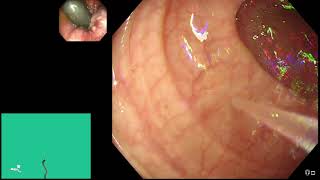 Endoscopy Top Tips: LGI - colonoscope insertion using the water immersion technique