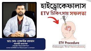 Success in ETV treatment for hydrocephalus || হাইড্রোকেফালাস || Endoscopic Third Ventriculostomy