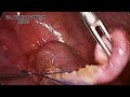 Laparoscopic appendectomy | Dr Anand prakash |