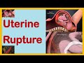 Uterine Rupture