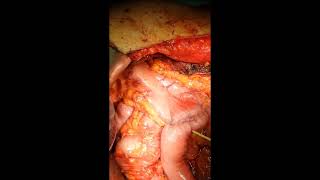 ANASTOMOSIS GASTRO JEJUNAL